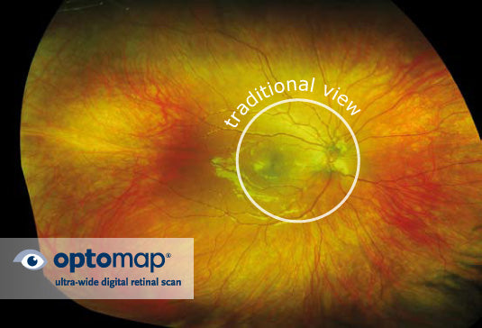 Wide-Field Retinal Photography versus Regular Retinal Imaging: Experience the Difference